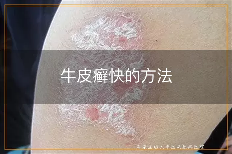 牛皮癣快的方法
