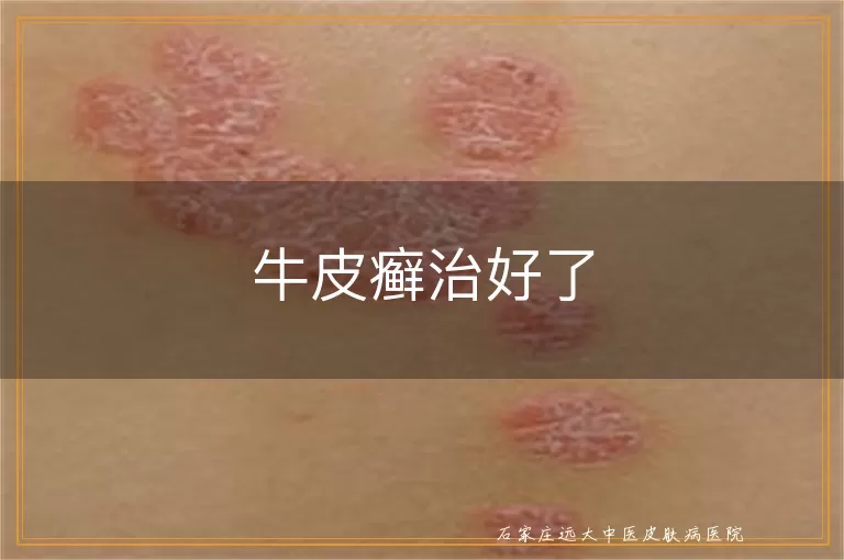 牛皮癣治好了