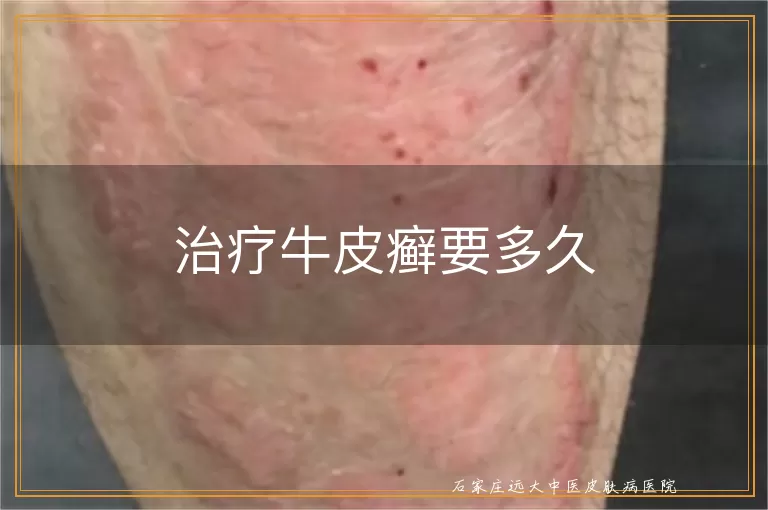 治疗牛皮癣要多久