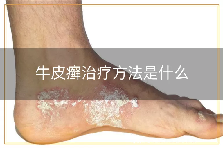 牛皮癣治疗方法是什么