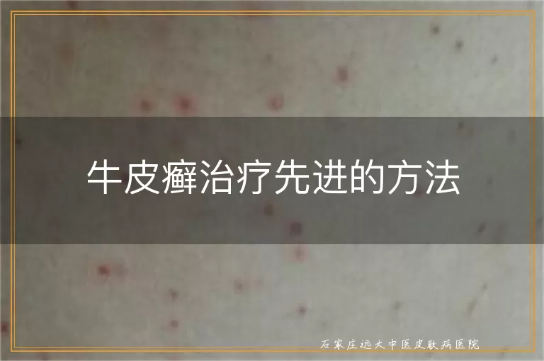 牛皮癣治疗先进的方法