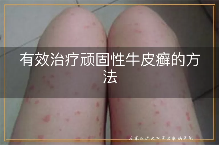 有效治疗顽固性牛皮癣的方法