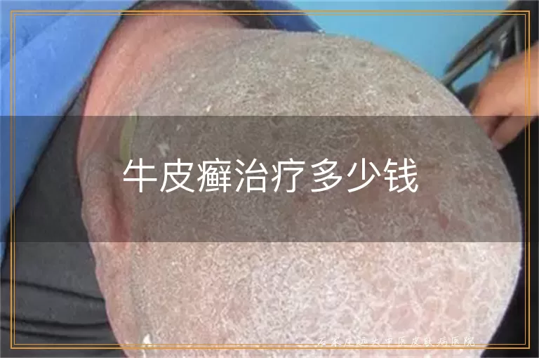 牛皮癣治疗多少钱