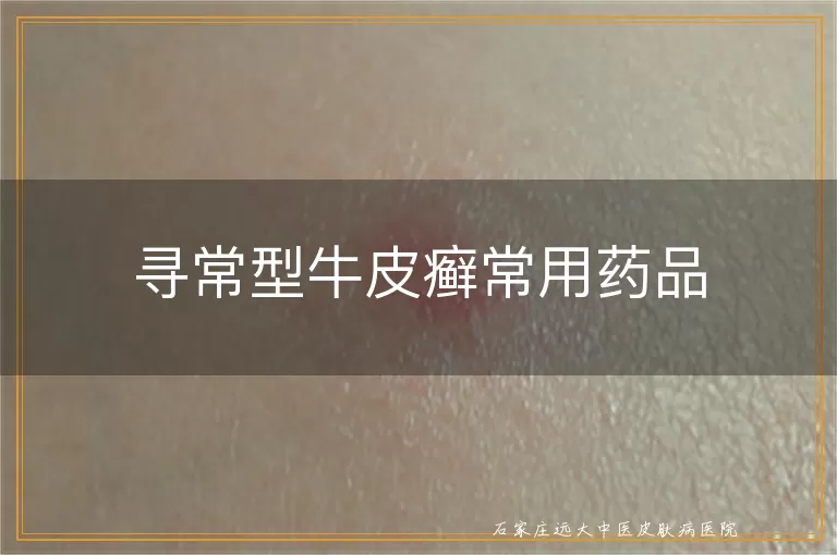 寻常型牛皮癣常用药品