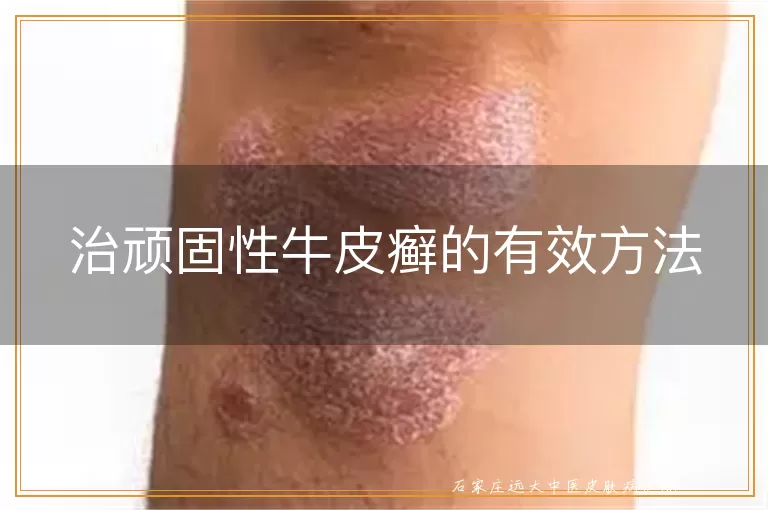 治顽固性牛皮癣的有效方法