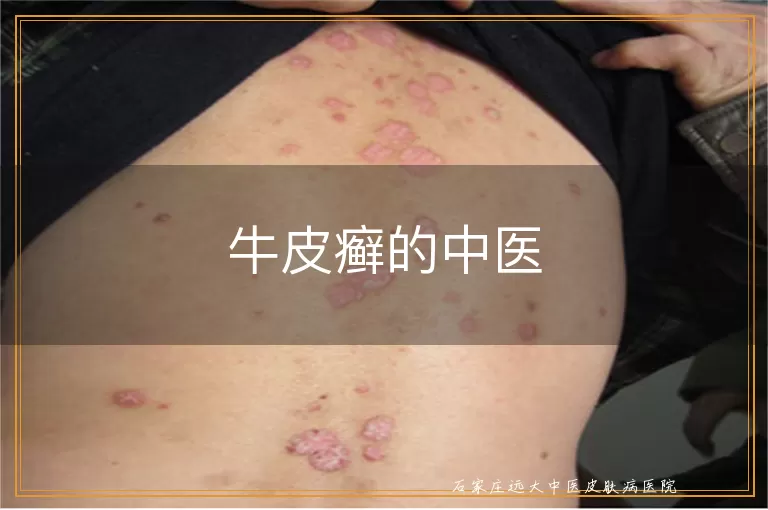 牛皮癣的中医