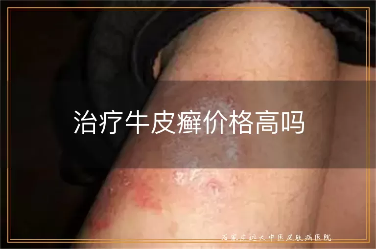 治疗牛皮癣价格高吗
