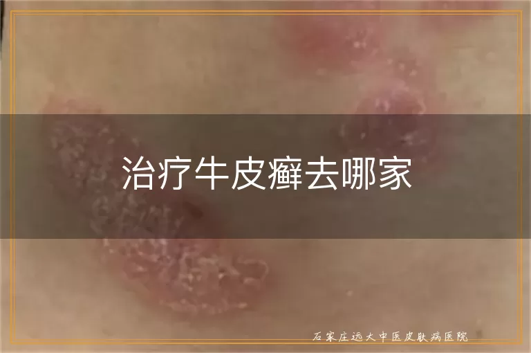 治疗牛皮癣去哪家