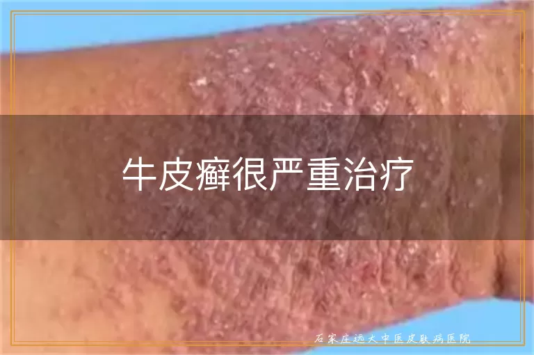 牛皮癣很严重治疗