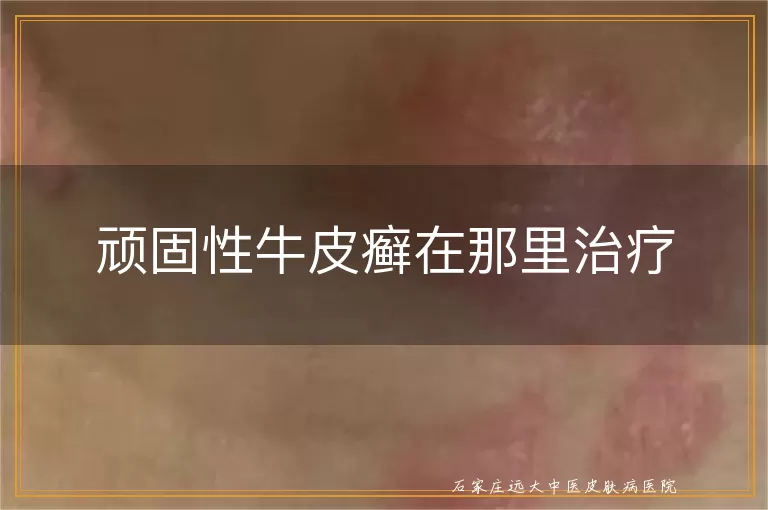 顽固性牛皮癣在那里治疗