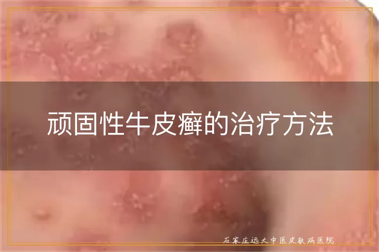 顽固性牛皮癣的治疗方法