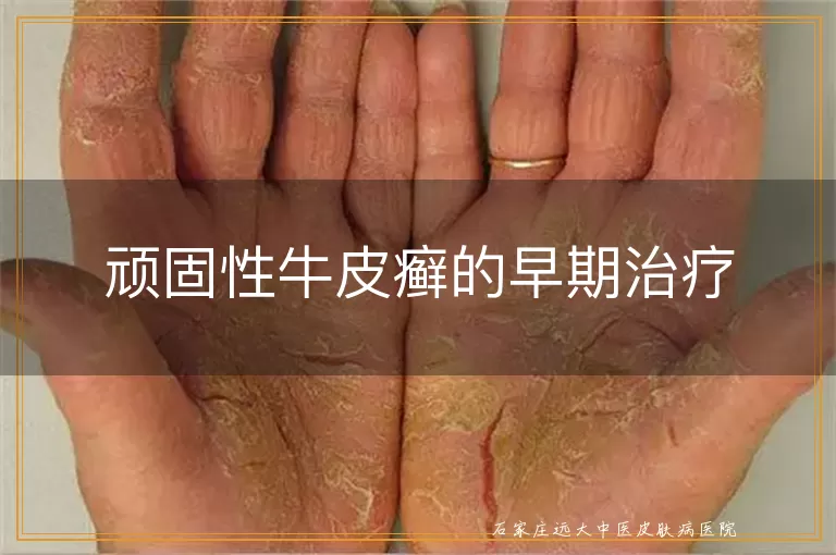 顽固性牛皮癣的早期治疗