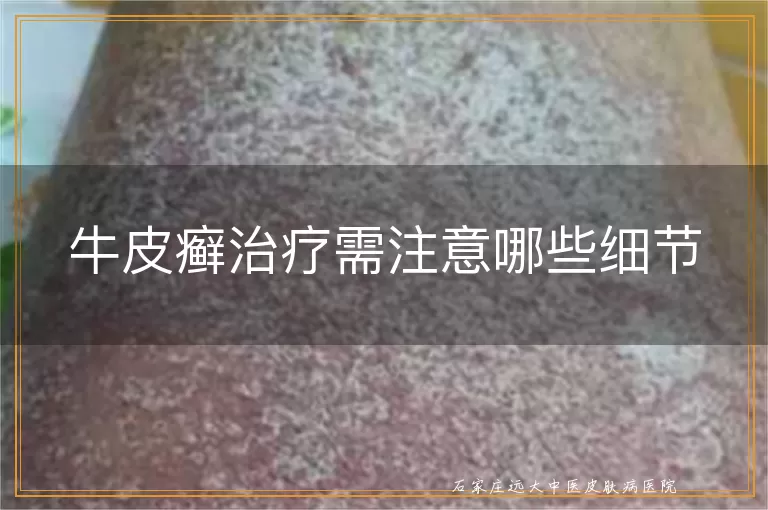 牛皮癣治疗需注意哪些细节