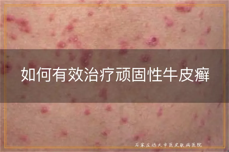 如何有效治疗顽固性牛皮癣