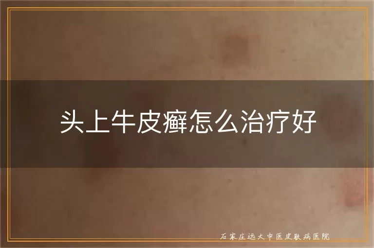 头上牛皮癣怎么治疗好