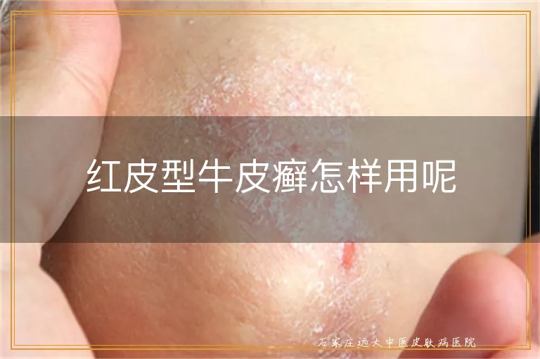红皮型牛皮癣怎样用呢