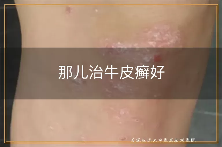 那儿治牛皮癣好