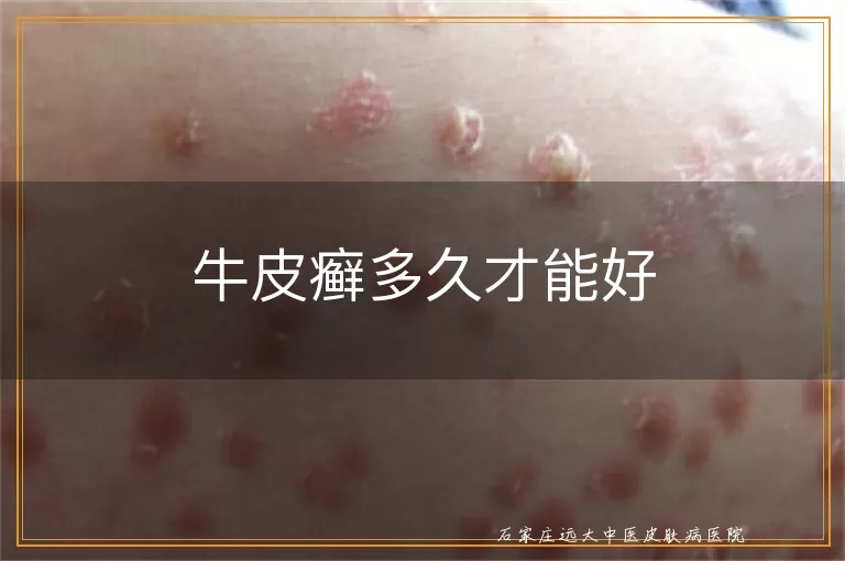 牛皮癣多久才能好