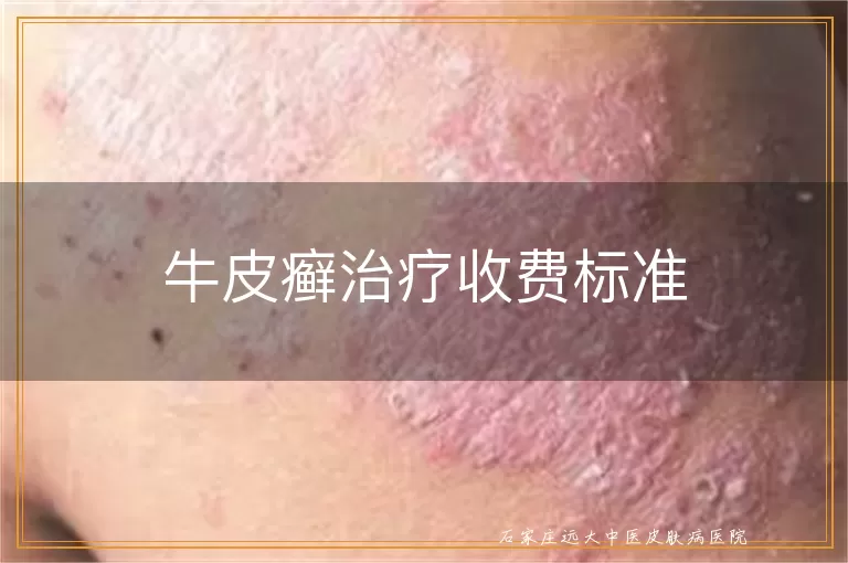 牛皮癣治疗收费标准