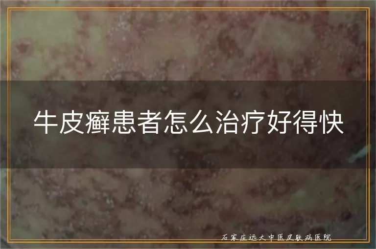 牛皮癣患者怎么治疗好得快