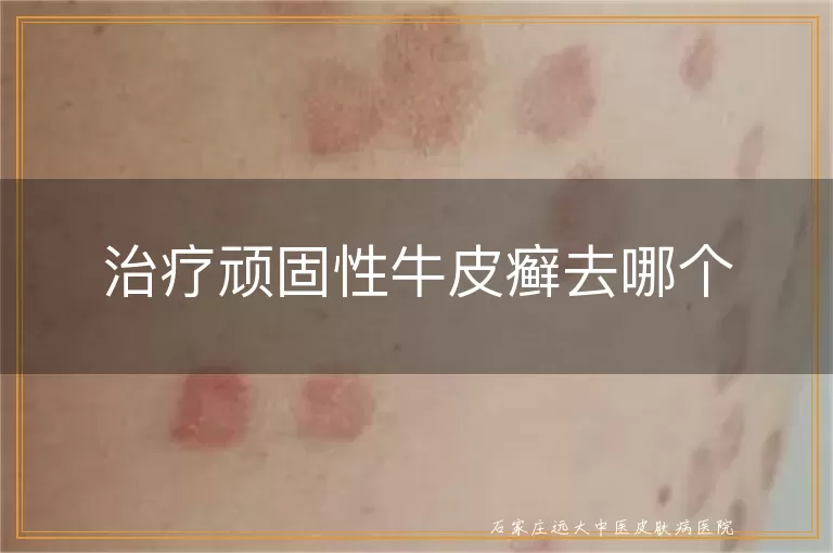 治疗顽固性牛皮癣去哪个