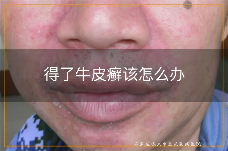 得了牛皮癣该怎么办