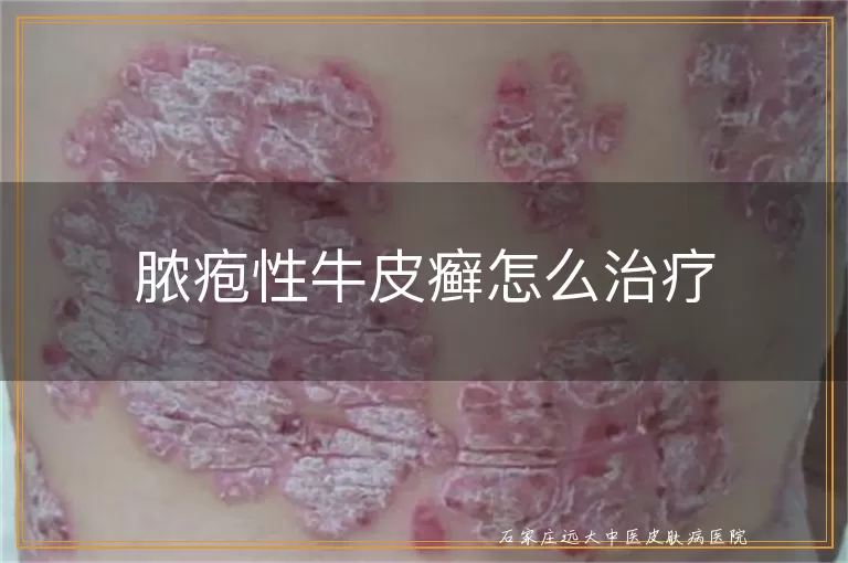 脓疱性牛皮癣怎么治疗
