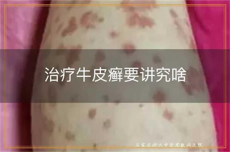 治疗牛皮癣要讲究啥