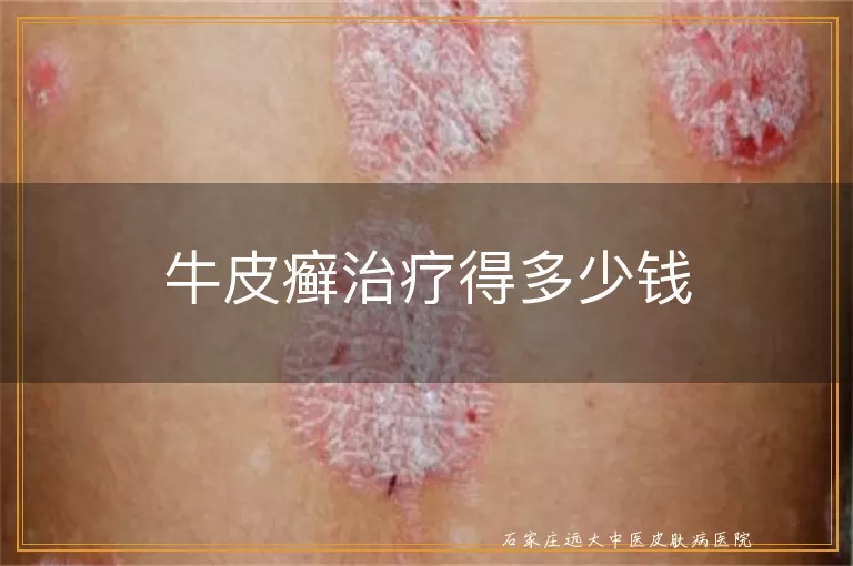 牛皮癣治疗得多少钱