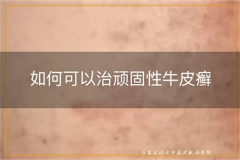 如何可以治顽固性牛皮癣