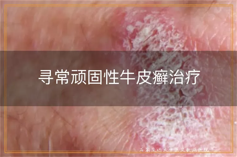 寻常顽固性牛皮癣治疗