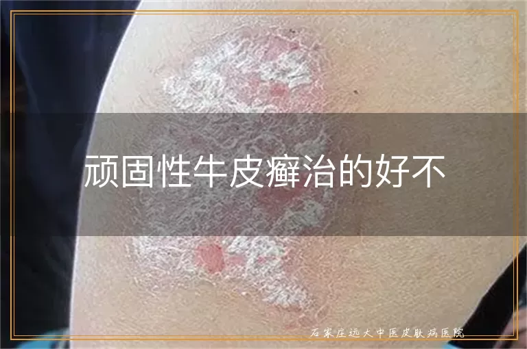 顽固性牛皮癣治的好不