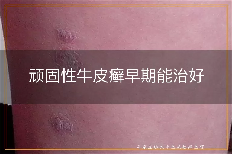 顽固性牛皮癣早期能治好