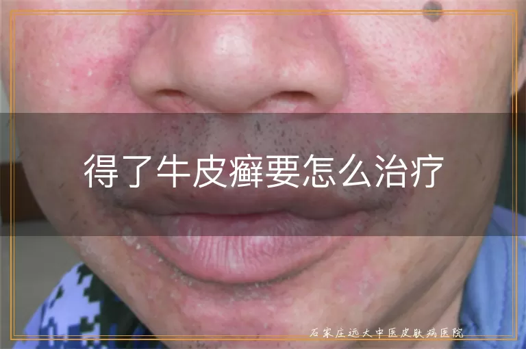 得了牛皮癣要怎么治疗