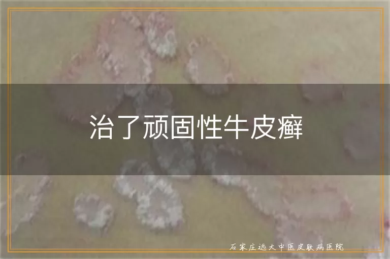 治了顽固性牛皮癣
