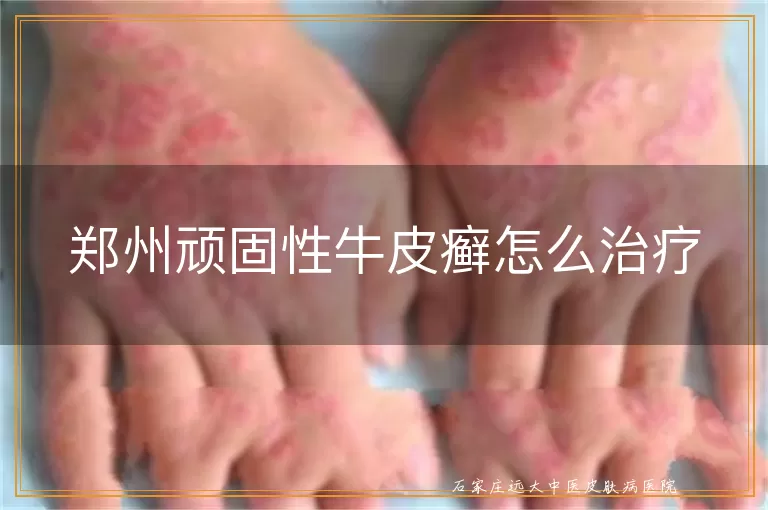 郑州顽固性牛皮癣怎么治疗