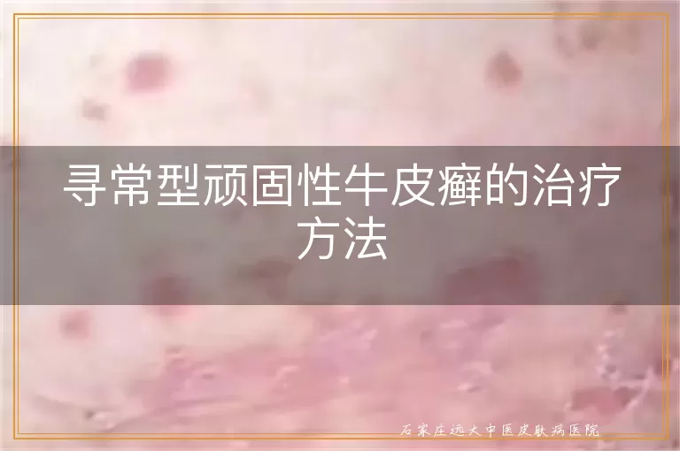 寻常型顽固性牛皮癣的治疗方法