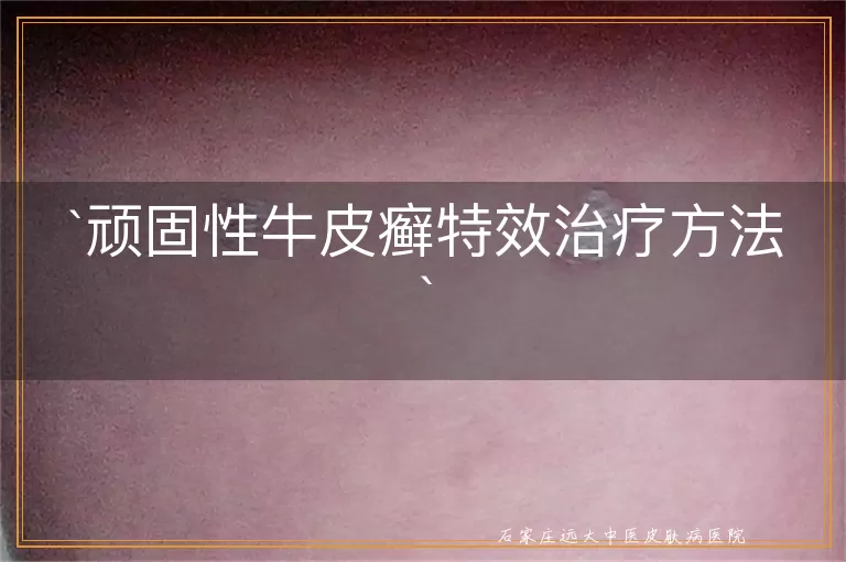 顽固性牛皮癣特效治疗方法