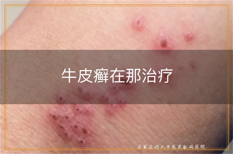 牛皮癣在那治疗