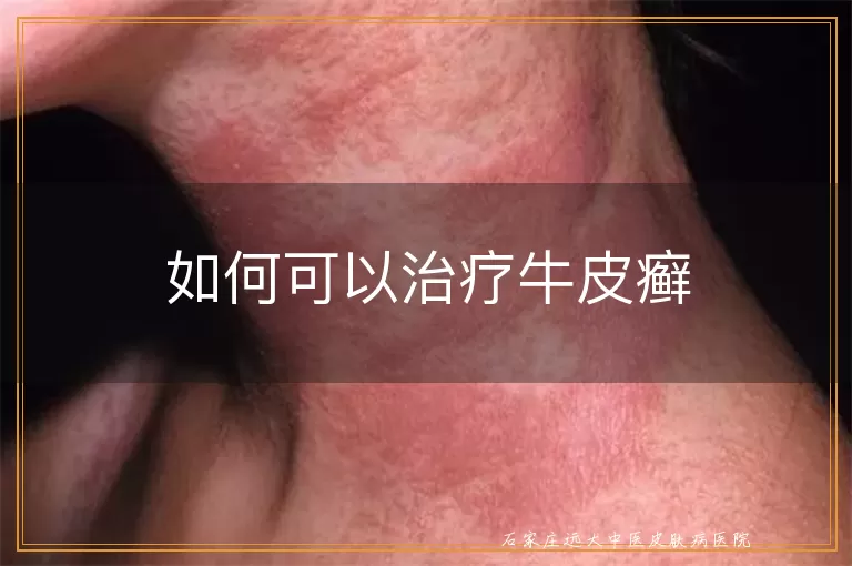 如何可以治疗牛皮癣