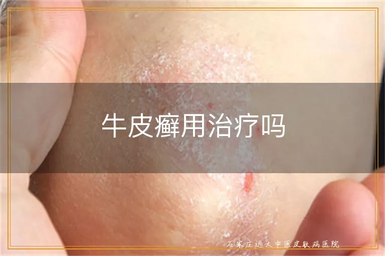 牛皮癣用治疗吗