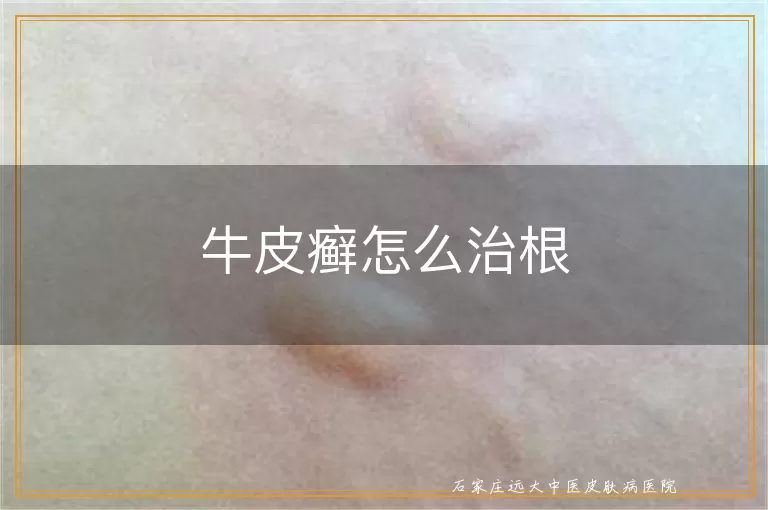 牛皮癣怎么治根