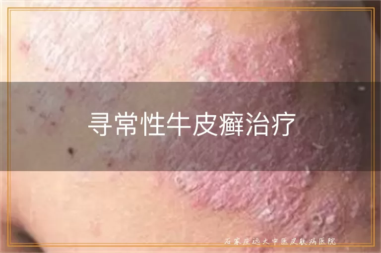 寻常性牛皮癣治疗