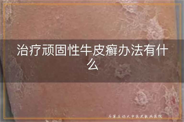 治疗顽固性牛皮癣办法有什么