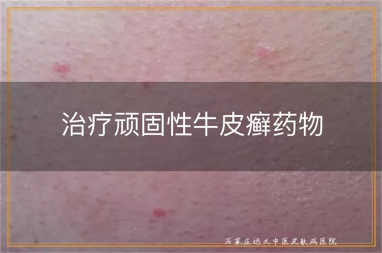 治疗顽固性牛皮癣药物