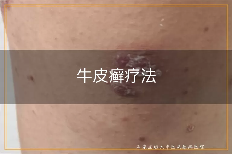 牛皮癣疗法