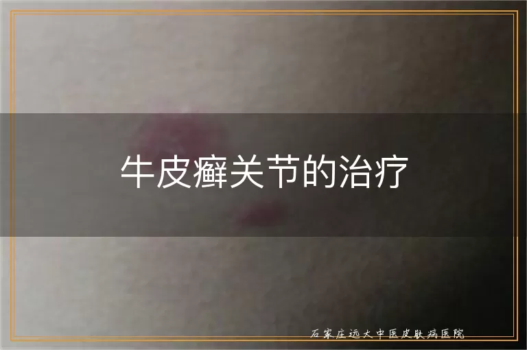 牛皮癣关节的治疗