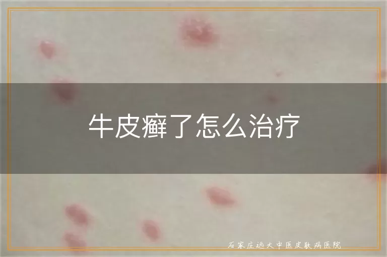 牛皮癣了怎么治疗