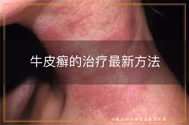 牛皮癣的治疗最新方法