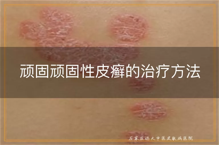 顽固顽固性皮癣的治疗方法